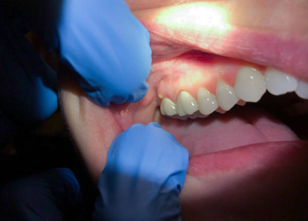 Best Emergency Dental Care for Abscessed Tooth in Crane, TX